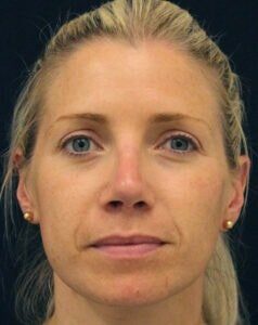 Case # 13 after photo