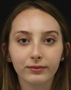 Case # 10 after photo