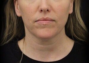 Case # 13 before photo