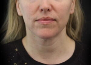 Case # 13 after photo