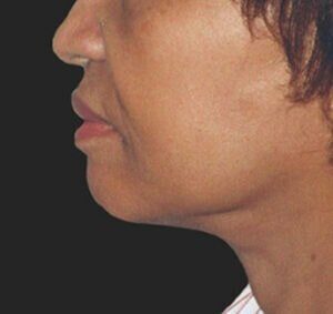 Case # 2 after photo