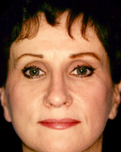 Case # 4 after photo