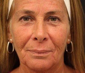 Case # 1 before photo