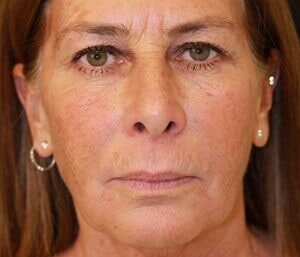 Case # 1 after photo