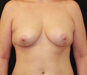 Case # 3 after photo