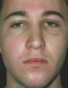 Case # 1 after photo