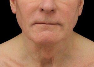 Case # 15 before photo