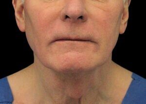 Case # 15 after photo