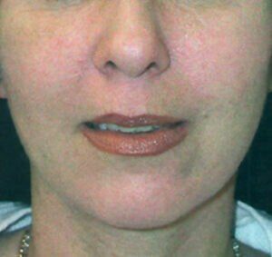 Case # 3 after photo