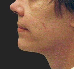 Case # 4 after photo