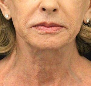 Case # 5 before photo