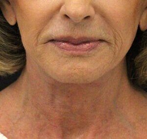 Case # 5 after photo