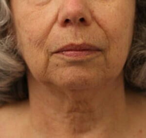 Case # 6 before photo