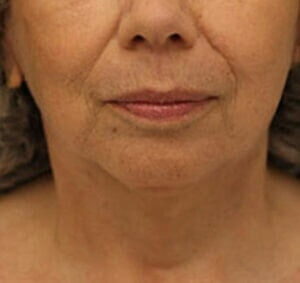 Case # 6 after photo