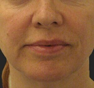 Case # 7 before photo