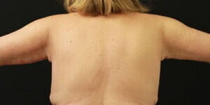 Case # 1 after photo