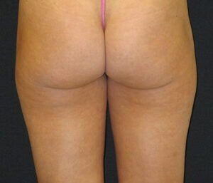 Case # 4 after photo