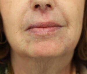 Case # 3 after photo