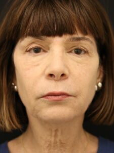 Case # 8 before photo