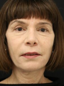 Case # 8 after photo