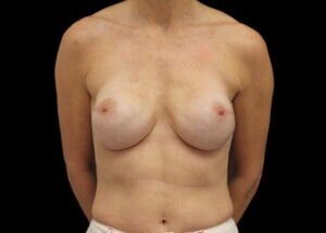 Case # 6 after photo