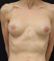 Case # 13 after photo