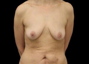 Case # 7 before photo