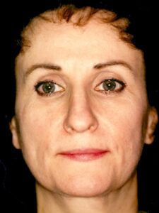 Case # 1 before photo