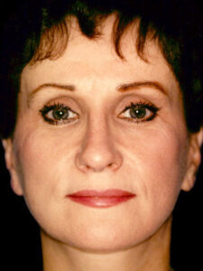 Case # 1 after photo