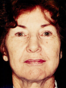 Case # 3 before photo