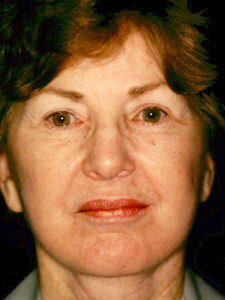 Case # 3 after photo