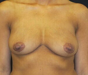 Case # 15 before photo