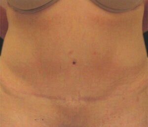 Case # 9 after photo