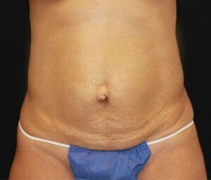 Case # 10 before photo