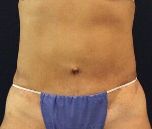 Case # 10 after photo