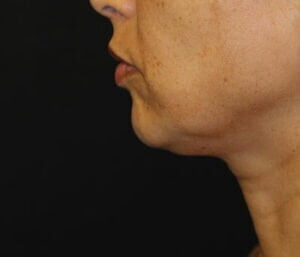 Case # 10 before photo