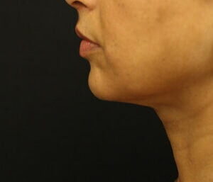 Case # 10 after photo