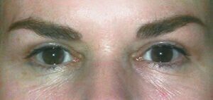 Case # 11 after photo