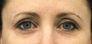 Case # 14 before photo