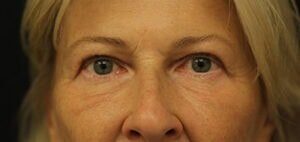 Case # 16 after photo