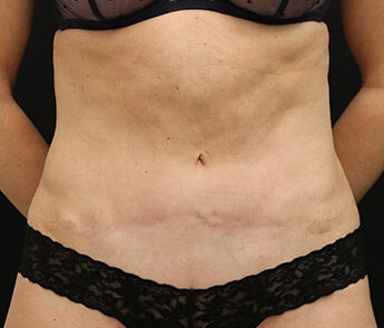 Case # 13 after photo