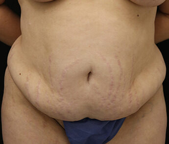 Case # 14 before photo