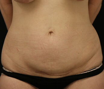 Case # 15 before photo