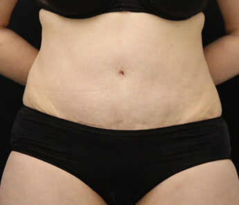 Case # 16 after photo