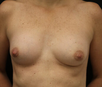 Case # 28 after photo