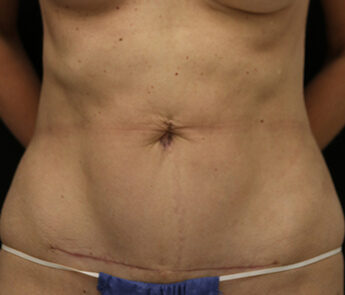 Case # 17 after photo