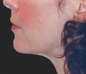 Case # 11 after photo