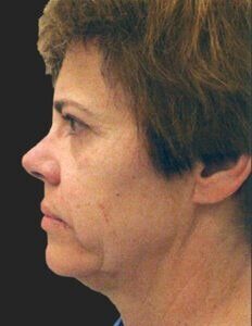 Case # 9 before photo