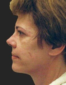 Case # 9 after photo