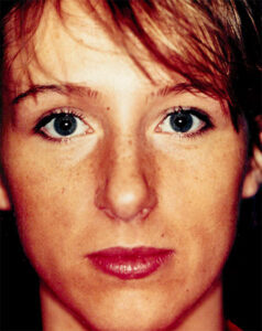 Case # 5 before photo